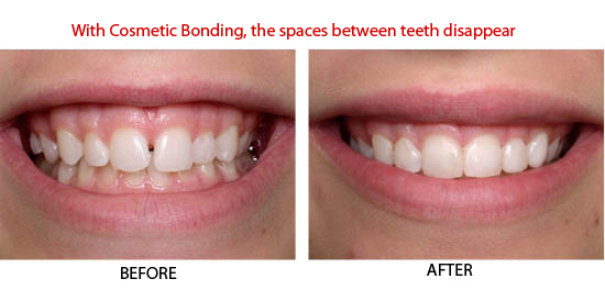 tooth bonding problems